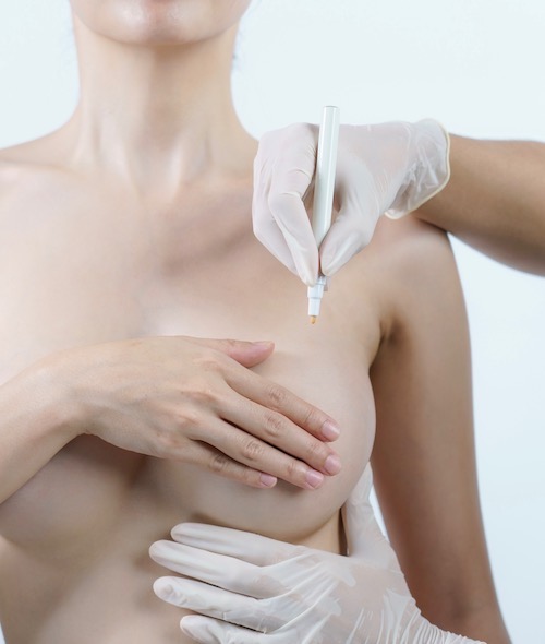 Sagging breasts and breast lift in Zug
